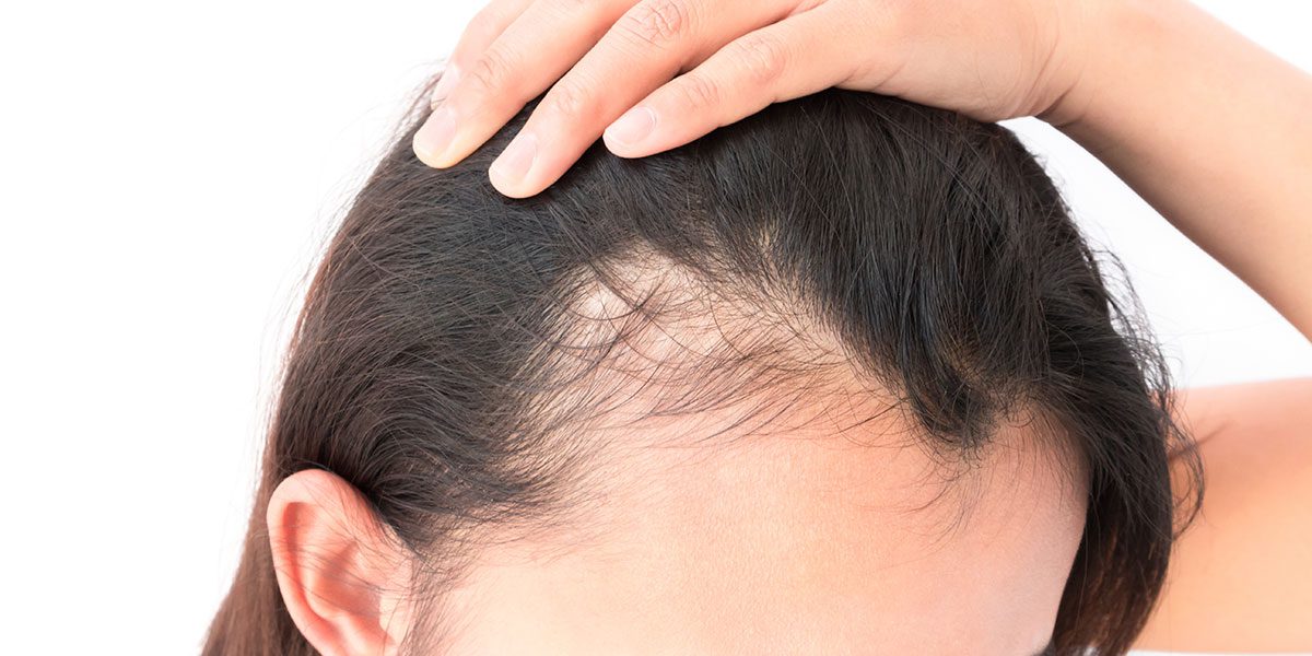 Hair loss: Patchy bald spots could regrow hair if an underlying STI is  treated | Express.co.uk